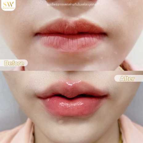 รีวิวฉีดฟิลเลอร์ปากที่ Sowon Clinic รูปที่ 7