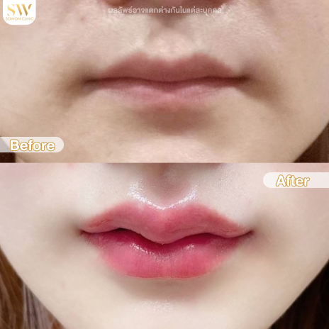 รีวิวฉีดฟิลเลอร์ปากที่ Sowon Clinic รูปที่ 8