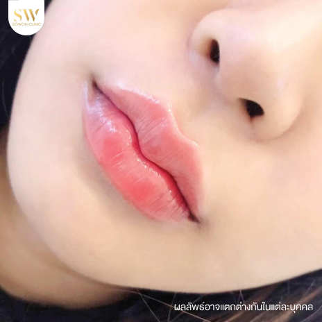 รีวิวฉีดฟิลเลอร์ปากที่ Sowon Clinic รูปที่ 10