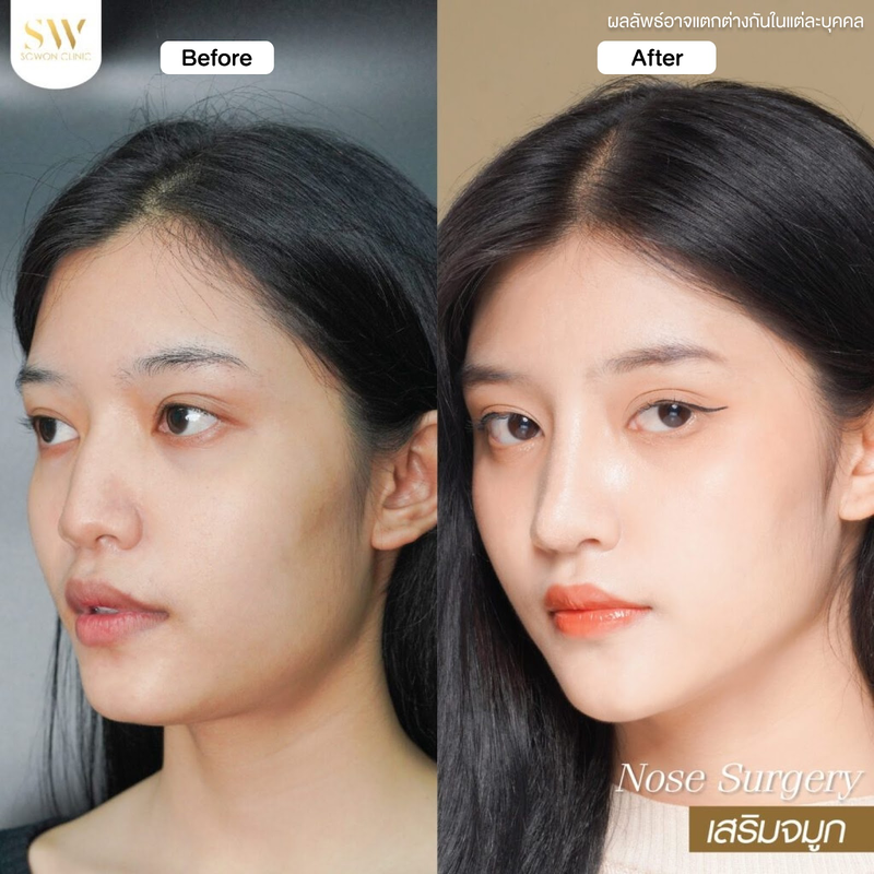 รีวิวเสริมจมูกที่ Sowon Clinic รูปที่ 1