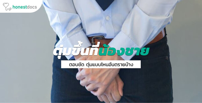 ตุ่มขึ้นที่อวัยวะเพศชาย ตุ่มขึ้นที่อวัยเพศชาย