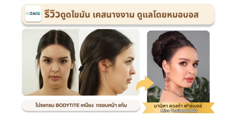 รีวิวดูดไขมันโดยมานิต้า นางสาวไทย