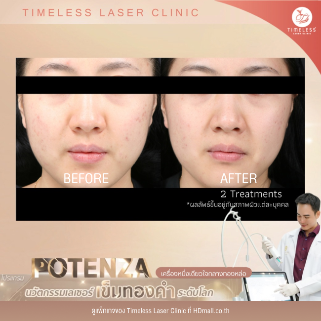 ผลลัพธ์หลังใช้บริการโปรแกรม Potenza ที่ Timeless Laser Clinic รูป 5
