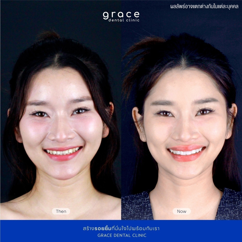 รีวิว ทำวีเนียร์ ที่ Grace Dental Clinic รูป 2