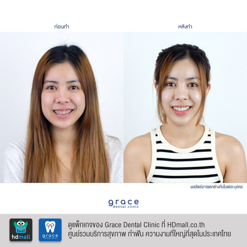 รีวิว ทำวีเนียร์ ที่ Grace Dental Clinic รูป 3