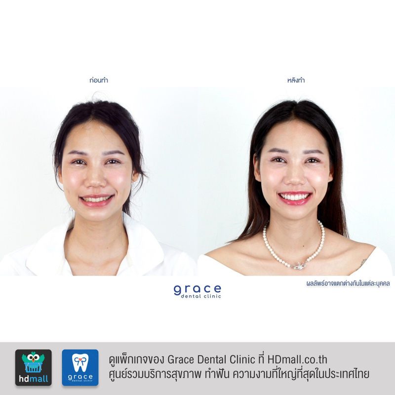 รีวิว ทำวีเนียร์ ที่ Grace Dental Clinic รูป 4