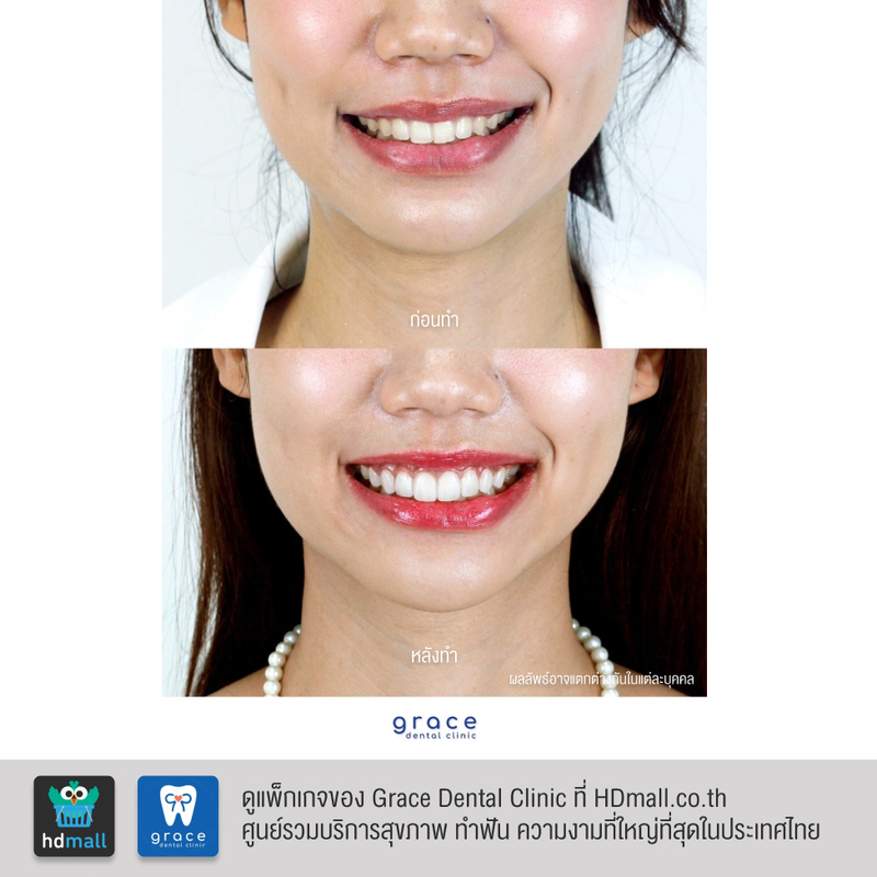 รีวิว ทำวีเนียร์ ที่ Grace Dental Clinic รูป 5