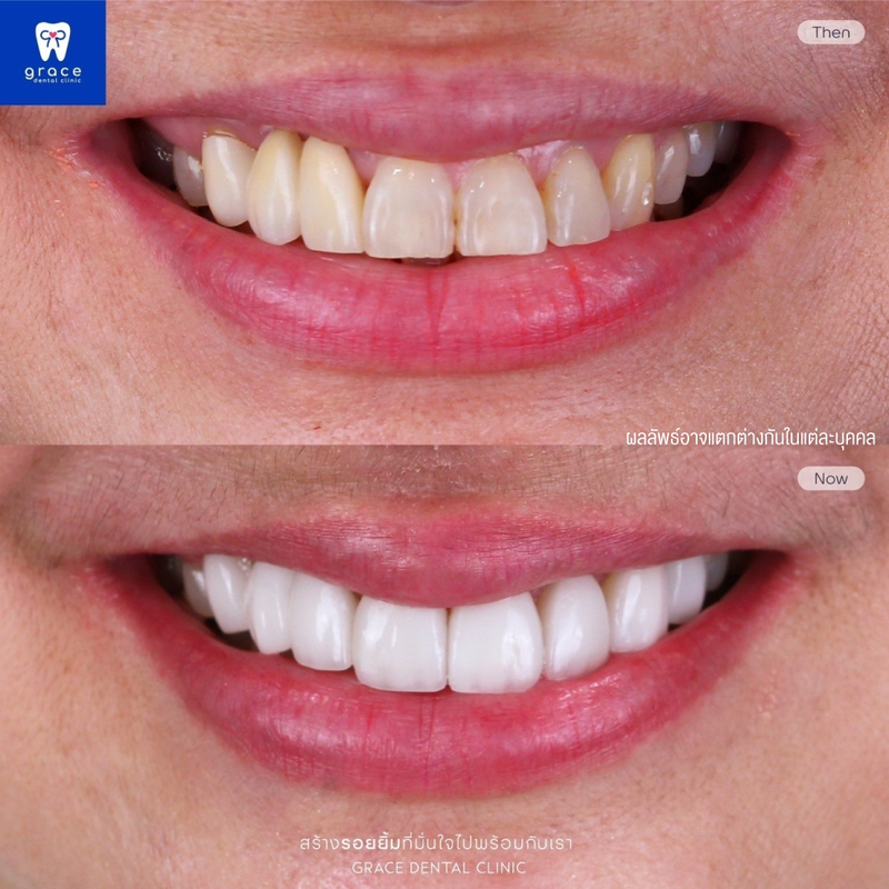 รีวิว ทำวีเนียร์ ที่ Grace Dental Clinic รูป 7