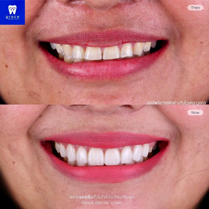 รีวิว ทำวีเนียร์ ที่ Grace Dental Clinic รูป 8