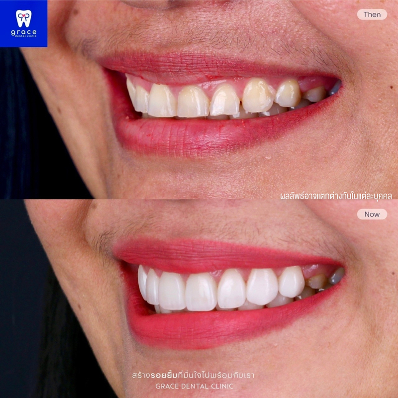 รีวิว ทำวีเนียร์ ที่ Grace Dental Clinic รูป 9