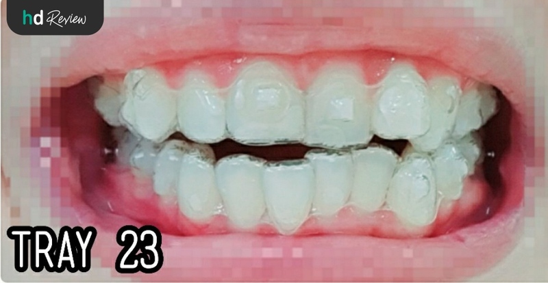 รีวิวจัดฟันแบบใส Invisalign Full ทั้งฟันบนและฟันล่าง